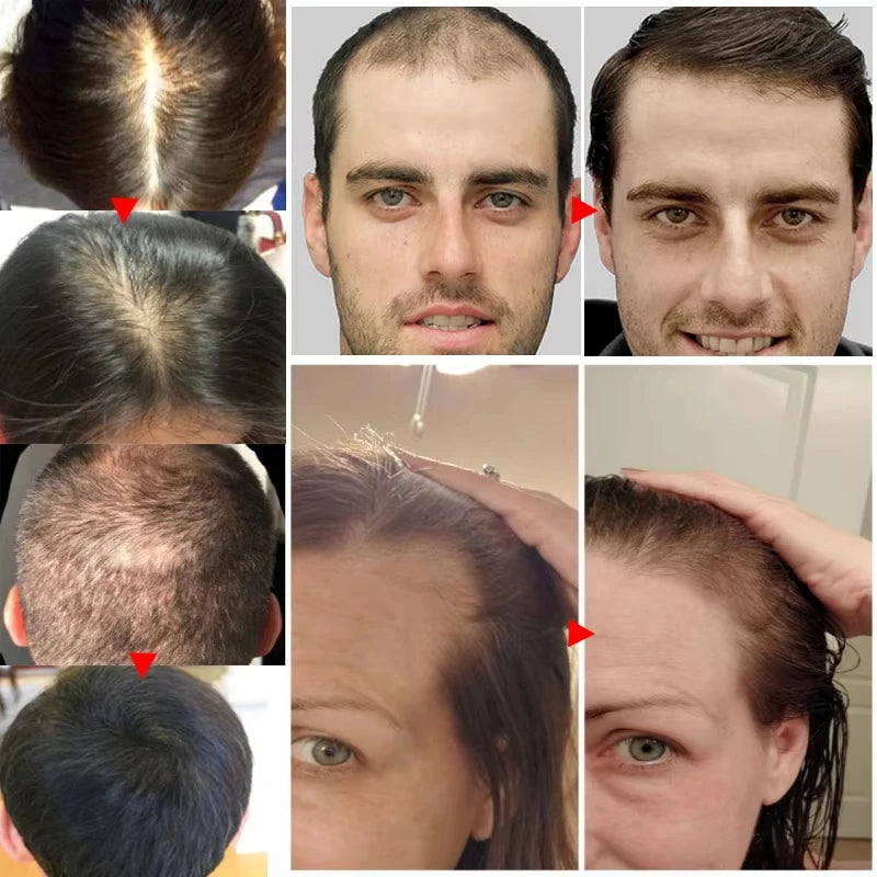 Fast Hair Growth Serum Spray anti Hair Loss Prevent Baldness Scalp Treatment Repair Roots Beauty Health Hair Care for Men Women